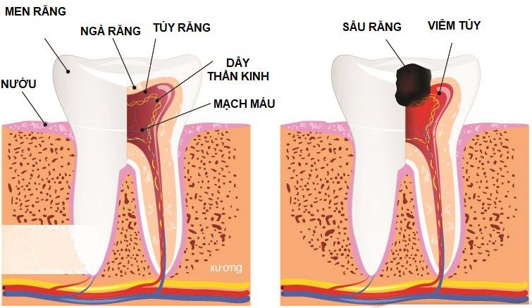 TUỶ RĂNG LÀ GÌ? DẤU HIỆU CỦA VIÊM TUỶ – QUY TRÌNH ĐIỀU TRỊ VIÊM TUỶ RĂNGrị!