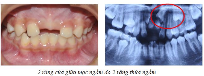 RĂNG MỌC NGẦM NHỔ HAY KHÔNG NHỔ
